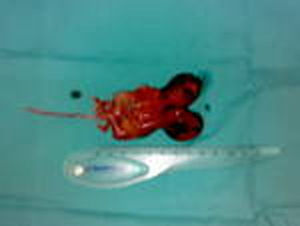 Imagen macroscópica de los fetos unidos por el tórax y la parte superior del abdomen.