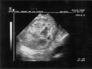 Útero aumentado de tamaño. Cavidad uterina ocupada por zonas hiper e hiporrefrigentes multiloculadas.