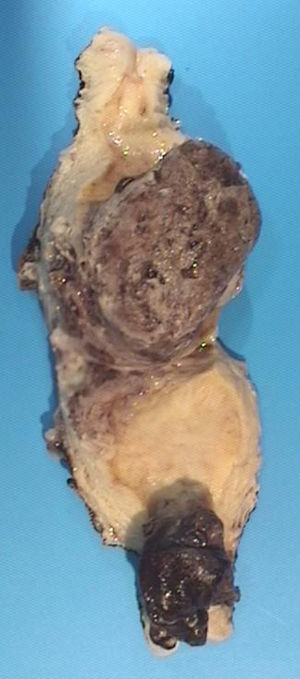 Sección sagital de cérvix y cuerpo uterino donde se observan las dos formaciones tumorales cervical y fúndico respectivamente.