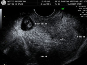 Ecografía transvaginal, visión longitudinal de útero con gestación en cicatriz de cesárea.