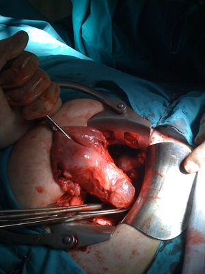 Saco gestacional visible en cara anterior ístmica uterina, tras disecar plica vesicouterina.
