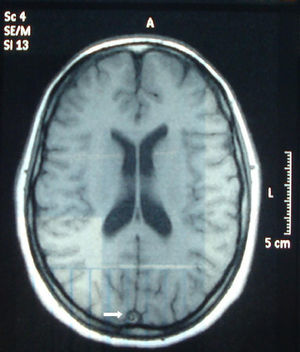 Imagen de RMN. Corte axial potenciado en T1. Flecha: imagen isointensa en seno longitudinal con relación a trombosis.