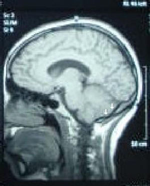 Imagen de RMN. Corte sagital. Flecha: se observa trombosis en seno longitudinal y prensa de Herófilo.