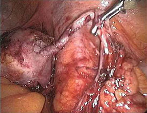 Imagen intraoperatoria de apéndice vermiforme y de mucocele.