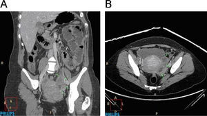 A y B) Tomografía abdominopélvica: lesión quística en anejo izquierdo con líquido libre (flecha).