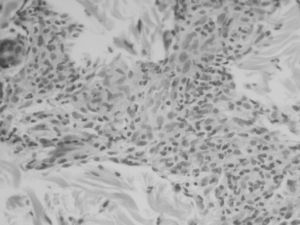 Tinción con hematoxilina-eosina×100: se visualizan alteraciones histológicas diagnósticas de sífilis (granulomas epitelioides e infiltrados inflamatorios con predominio de células plasmáticas).