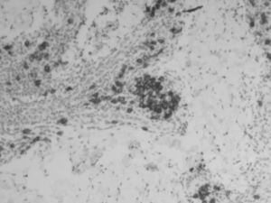 Tinción PAS×100: identificación del Treponema Pallidum.