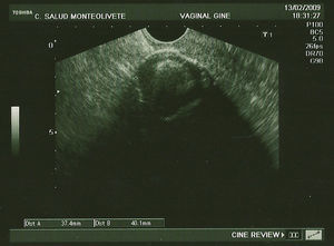 Ecografía vaginal. Mioma calcificado.