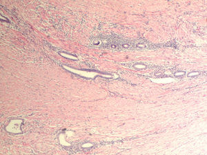 Glándulas y estroma endometrial dispersas en la capa muscular propia.