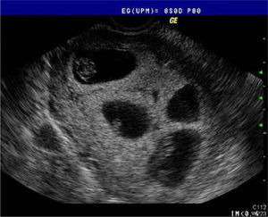 Útero que alberga gestación múltiple, tetracorial tetramniótica, con LCF de todos los fetos.