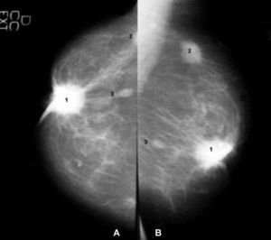 Lesion BIRADS 5. Proyección cráneo-caudal (A) y proyección oblícua mediolateral (B) de una mama, con una lesión (1) nodular, retroareolar, de márgenes espiculados, de alta densidad, con retracción del pezón y calcificaciones irregulares y heterogéneas asociadas. Se identifican otras dos lesiones, la (2), de similares características, localizada en el cuadrante supero-externo (no se visualiza en su totalidad en la proyección cráneo-caudal). La lesión (3) es una lesión satélite de la 1. Se trata de un carcinoma multifocal.