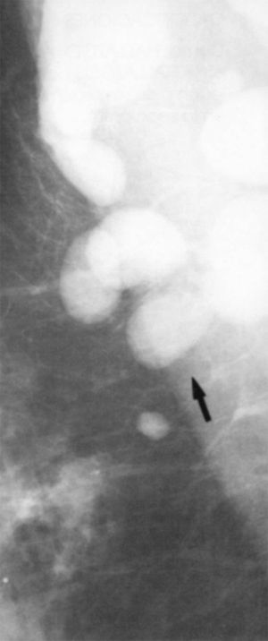 Adenopatías axilares.