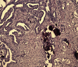 Superficie ovárica: cuerpos de psamoma entremezclados con estructuras glandulares conservadas (adendocarcinoma).