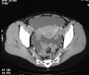 TAC abdominopélvico. Se observan implantes peritoneales, engrosamiento del peritoneo anexo al útero y líquido libre.