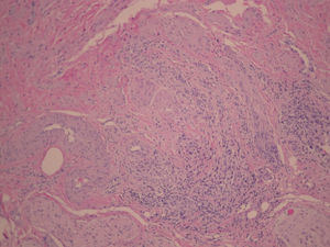 Corte histológico de la lesión vulvar compuesto por células de músculo liso.