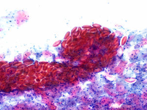 Citología del caso 3 (Papanicolaou, 10×). Múltiples huevos de oxiuros.