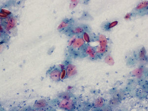 Citología del caso 3 (Papanicolaou, 10×). Huevos de oxiuros aislados entre las células vaginales. Infección por vaginosis bacteriana.