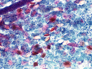 Citología del caso 3 (Papanicolaou, 10×). Huevos de oxiuros entre las células vaginales. Se aprecian las larvas dentro de los huevos.