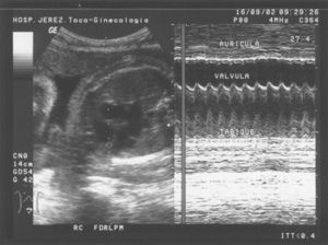 Estudio en modo m: frecuencia cardiaca fetal de 251lpm.