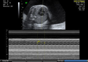 Modo M: frecuencia cardiaca fetal 277lpm.