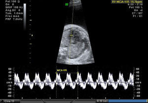 Modo M: frecuencia cardial 157lpm.