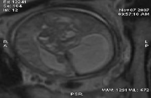 Resonancia magnética fetal. Corte axial donde se observa tumoración en la línea media anterior, de 4×4cm, con áreas solidoquísticas e hidrocefalia compresiva asimétrica.