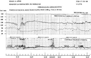 Al inicio el valor de la FCF basal fue de 155 latidos; a la hora 0:07 1/2 se produjo un Dip Tipo ii con amplitud de 80 latidos y decalage de 54s, los ascensos transitorios con amplitud de 15 latidos; la reserva de oxígeno fetal fue baja.