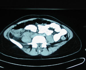 TAC pélvica con imagen de trombosis venosa séptica de vena ovárica derecha.