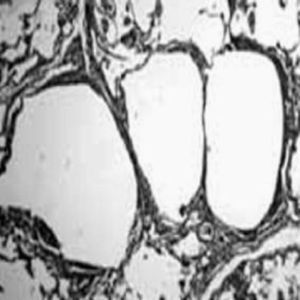 Imagen microscópica de la linfangioleiomiomatosis.
