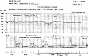 La FCF basal fue de 140 latidos. A la hora 0:21 3/4 se produjo un dip tipo ii con amplitud de 18 latidos y decalage de 48s; a partir del minuto 0:34 1/2 se registraron aceleraciones de pequeña amplitud, la reserva de oxigeno fetal es baja.