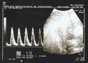 Morfología de la onda velocidad-flujo (OVF) de la arteria umbilical del feto sano en la semana 34, con disminución de la fase diastólica.