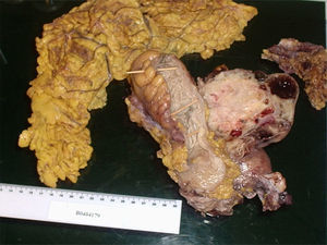 Tumoración en ovario derecho. No se observa tumor macroscópico en la resección intestinal.