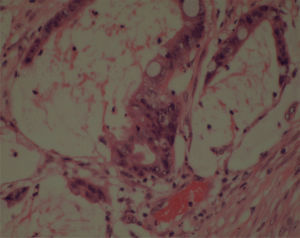 Teratoma ovárico con epitelio mucosecretor, atípico, de tipo intestinal, flotando en material mucoide. H-E 20X.