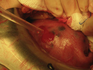 Útero aumentado de tamaño como 10 semanas de gestación de consistencia blanda, con implantes en serosa y un sangrado activo por una perforación en fondo.