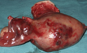Ovario izquierdo engrosado.