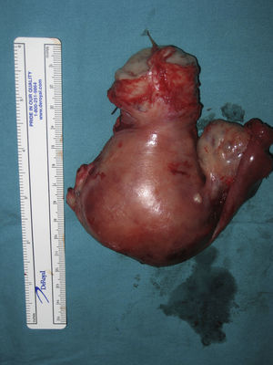Histerectomía total abdominal más anexectomía izquierda.