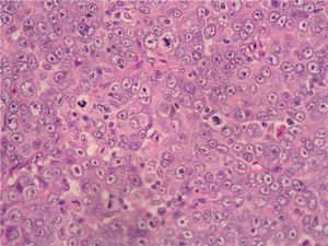 Carcinoma primario de trompa uterina (HE, x10).