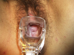 LEUCORREA CREMOSA, con espéculo vaginal, al fondo de la vagina, y sobre el cérvix uterino, bien epitelizado.