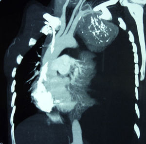 TC. Obsérverse gran masa que con vascularización procedente de la arteria subclavia (flecha blanca). Derrame pleural y colapso pulmonar asociado (flechas negras).