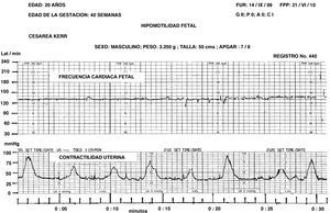 La FCF basal durante 30 min se mantuvo en 130 latidos, el producto probablemente permaneció inmóvil a causa de la hipoxia crónica fetal.