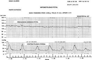 El registro de la FCF sin variabilidad es frecuente cuando existe hipomotilidad, el feto duerme y sus músculos están relajados el consumo de oxígeno es menor.