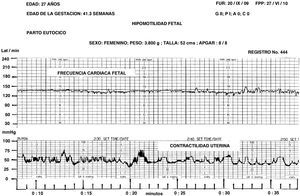 El registro de la FCF sin variabilidad indica sufrimiento fetal crónico cuya etiología es la hipoxia crónica fetal.