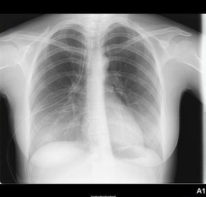 Radiografía de tórax de neumotórax derecho con drenaje endopleural derecho.