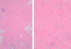 Estroma fibroso con áreas de HEPA.