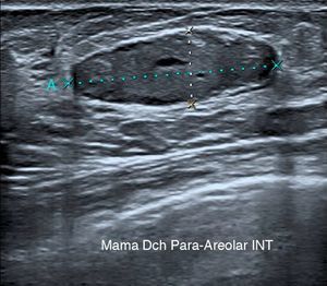 Mamografía: Nódulo retroareolar derecho de 4,5cm, de contornos bien delimitados.