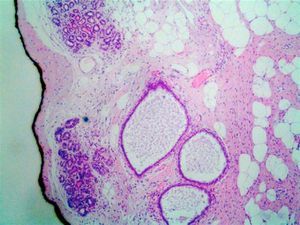 Estroma fibroso con focos de hiperplasia estromal pseudoangiomatosa (HEPA).