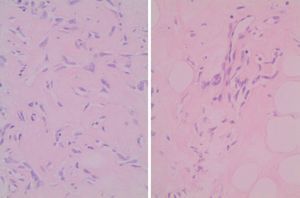 Carcinoma intraductal comedo GIII con áreas de HEPA.