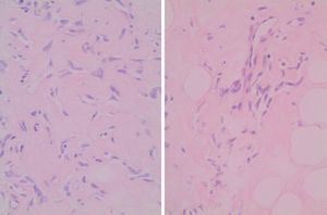 Carcinoma intraductal comedo GIII con áreas de HEPA.