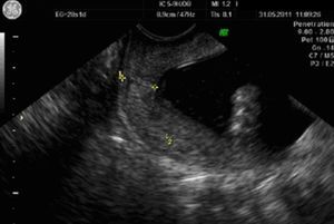 Se evidencia acortamiento de cérvix, longitud de 11mm sin embudización.