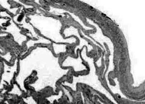 Imagen microscópica del linfangioma.